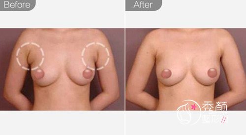 切除副乳手术多少钱,切副乳和隆胸能一起做吗?