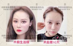 何照華磨骨技術怎么樣?有失敗案例嗎?