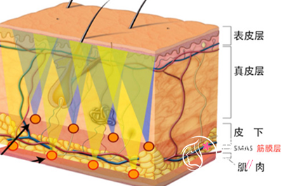 面部年轻化之高位SMAS除皱术
