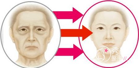 什么是3D童颜除皱术?大概需要多少钱?有没有后遗症?果好不好?