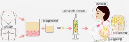 什么是3D童颜除皱术?大概需要多少钱?有没有后遗症?果好不好?