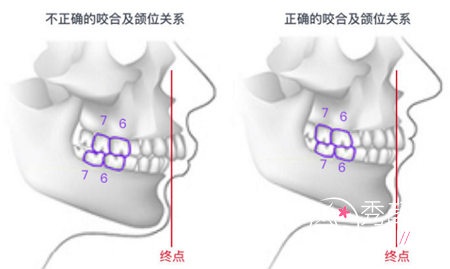 下巴后缩做矫正手术多少钱,有没有后遗症?