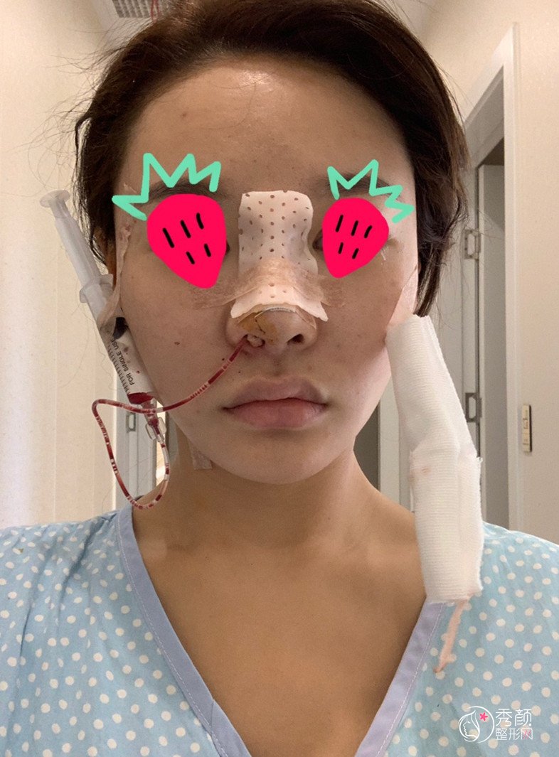 武汉哪个医生鼻修复做得好,刘波鼻修复案例。