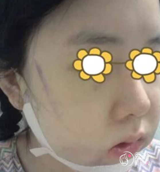 坐诊上海的韩国医生吉玟锡磨骨怎么样|术前术后案例对比