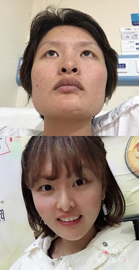 上海华美与九院哪个磨骨好技术口碑案例大对比