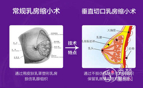 杭州美莱栗勇做巨乳缩小手术真的好吗,缩胸术前术后图片对比。