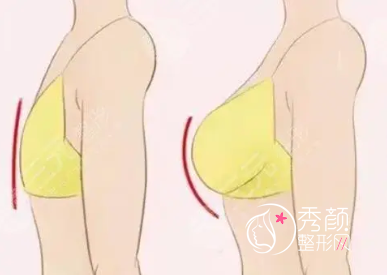 在上海做个假体隆胸大概需要多少钱？