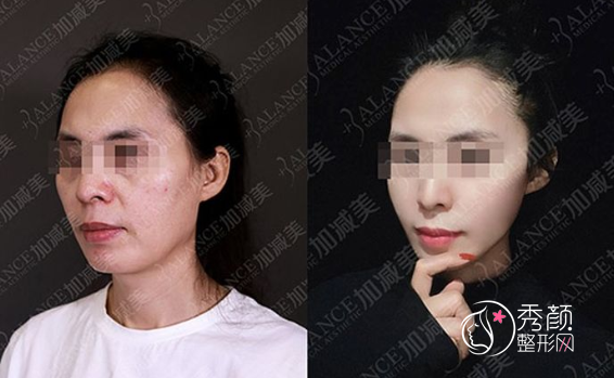 北京加减美面部提升怎样，面部提升案例术前术后照片对比。