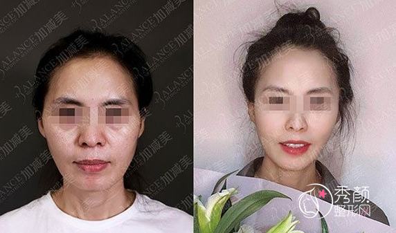 北京加减美面部提升怎样，面部提升案例术前术后照片对比。