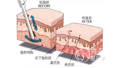 抽脂会致人死亡？吸脂手术有没有适应症和禁忌症？