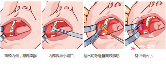 脸大只能磨骨吗？还有什么瘦脸方式？