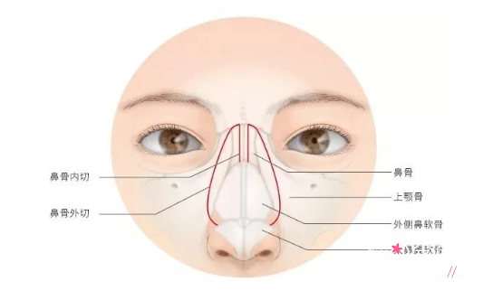 鼻骨内推是长期的吗?鼻骨内推有风险吗?果好不好?后遗症?
