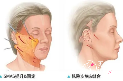 大拉皮手术除皱能维持多久？大概多少钱？注意事项和风险。