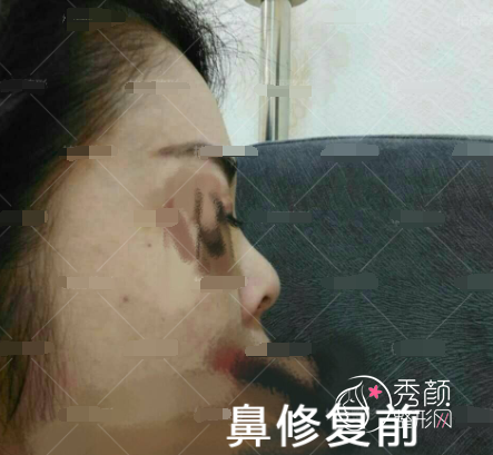 李劲良鼻修复亲身经历分享给大家看看李劲良技术到底怎么样！