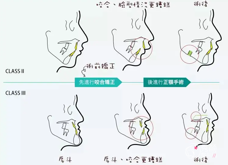 做正颌手术前一定要做正畸吗？