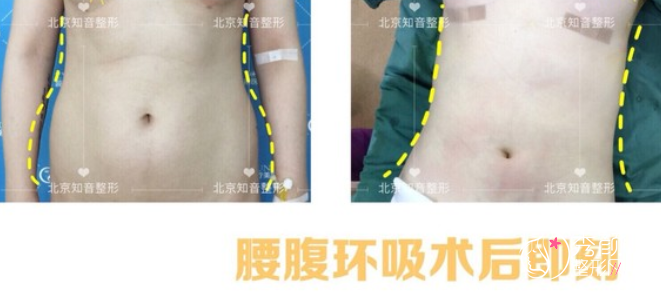 北京知音李奇军做吸脂手术怎么样，附腰腹吸脂案例展示