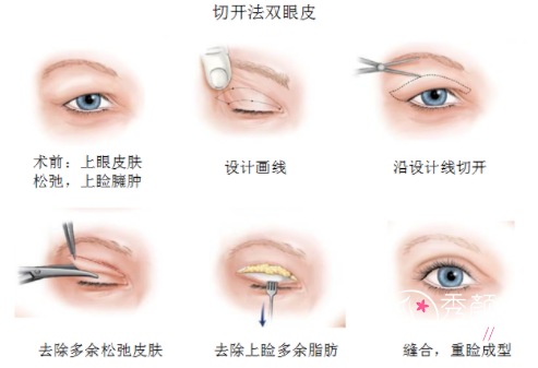 北京协和医院做双眼皮手术怎么样，大概多少钱？