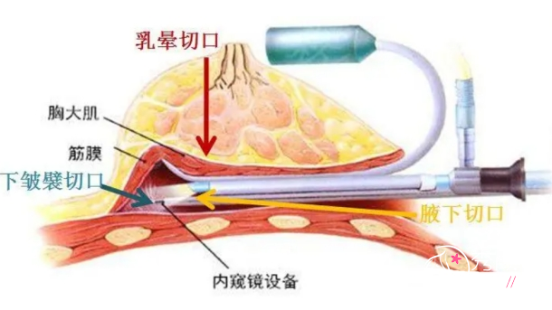 隆胸手术切口怎么选？腋窝切口vs乳晕切口vs下皱襞切口