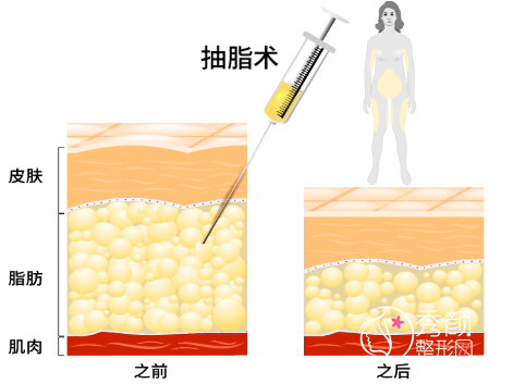 重庆军美整形医院吸脂怎么样|附抽脂减肥价格表一览