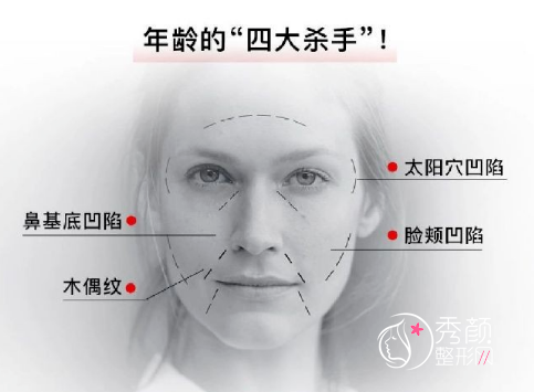 太阳穴凹陷、鼻基底凹陷、脸颊凹陷、木偶纹怎么选择填充材料？