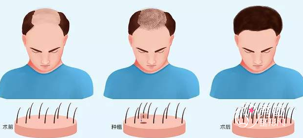 公立三甲医院可以植发吗？2023植发价格一览表