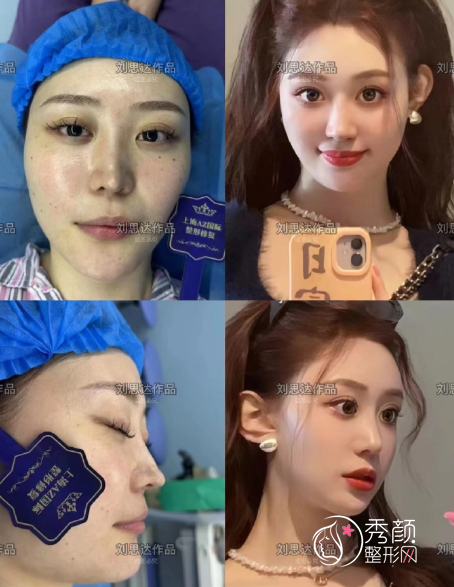 上海刘思达医生做鼻子怎么样,有没有失败案例?附隆鼻案例