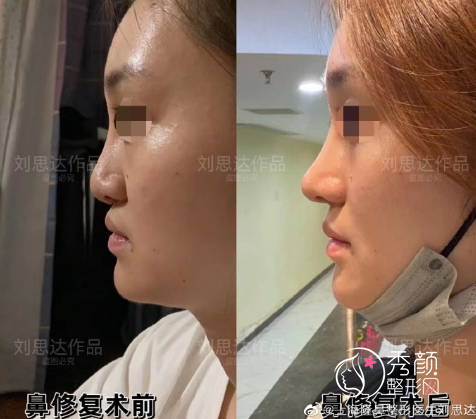 上海刘思达医生做鼻子怎么样,有没有失败案例?附隆鼻案例
