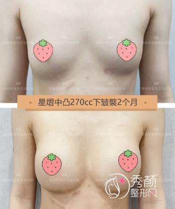 深圳思莉医疗美容张亚梅医生隆胸技术怎么样，有没有失败案例？
