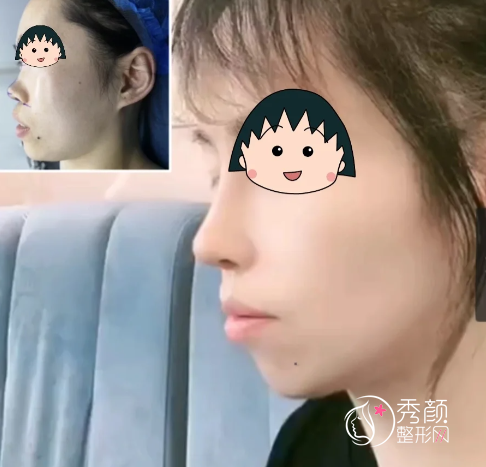 上海爱度医疗美容何世硕做鼻子怎么样，有没有隆鼻失败案例？