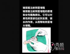 玻尿酸增粗手术可以维持 玻尿酸增粗手术可以维持