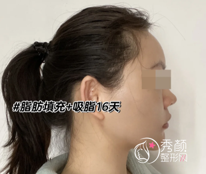 厦门吸脂医院哪家比较好?厦门吸脂正规医院+医生介绍