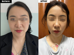 上海小拉皮手术哪个医院 上海小拉皮手术哪个医院