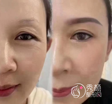 北京提眉术哪家医院做的好?华韩|客来美舍|美莱性价比高