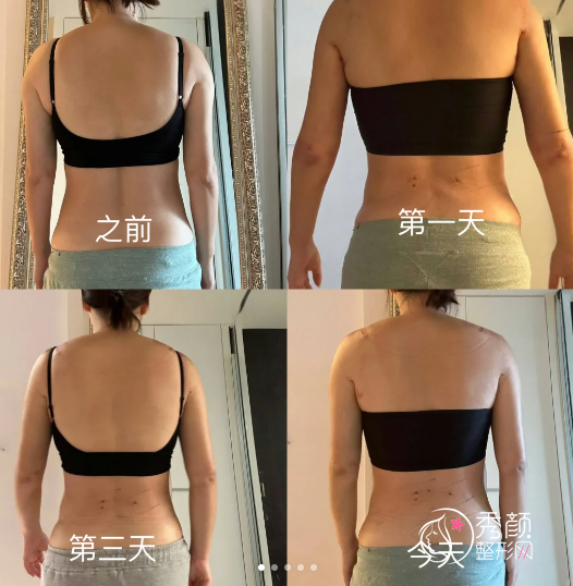 济南吸脂手术哪家医院好一点?公立三甲医院和脂肪专科医院整理