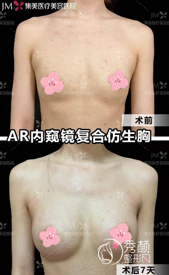 郑州集美赵亮医生隆胸怎么样?赵亮医生个人简介|假体隆胸案例