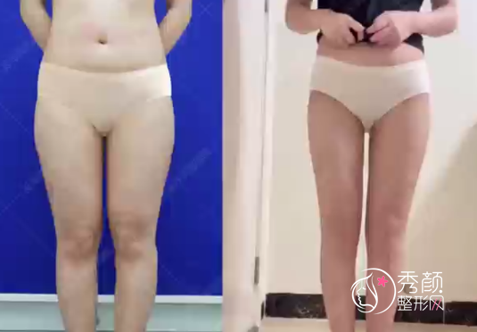 广州军美王世虎吸脂很厉害吗?附王世虎腿部吸脂真实案例