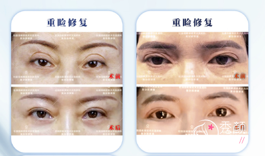 上海爱尚丽格杜园园双眼皮修复怎么样?修复成功率超高!