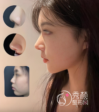 郑州隆鼻哪家医院好?郑州正规隆鼻医院+口碑医生介绍