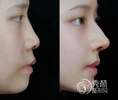 南昌隆鼻哪家医院好?南昌隆鼻正规医院+口碑医生介绍