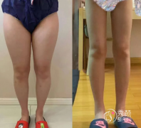 成都吸脂的医院哪家好? 成都吸脂的医院哪家好?