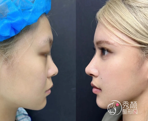 西安隆鼻医院哪家好?西京医院|高一生|壹加壹等医院技术各异