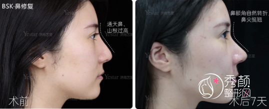 济南艺星孟庆杰隆鼻怎么样,有没有失败案例?附隆鼻案例展示