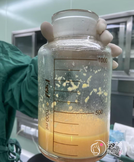 北京冯斌吸脂为什么那么贵?冯斌脂雕点脂成金塑形好、存活率高!