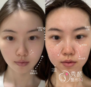 深圳轮廓固定医院哪家好 深圳轮廓固定医院哪家好