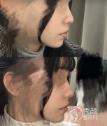 沈阳隆鼻出名的医院哪家 沈阳隆鼻出名的医院哪家