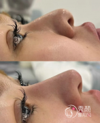 武汉注射玻尿酸隆鼻好的 武汉注射玻尿酸隆鼻好的