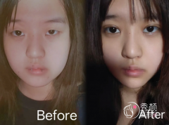 天津割双眼皮医院排名, 天津割双眼皮医院排名,