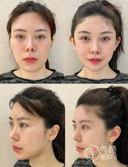 南京幼态脸注射医生排名:吴文欢、刘琳娜、晏义兵、王春娟…技巧强