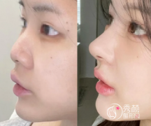 佛山玻尿酸注射隆鼻哪里 佛山玻尿酸注射隆鼻哪里