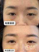 成都去眼袋好的医院有哪 成都去眼袋好的医院有哪